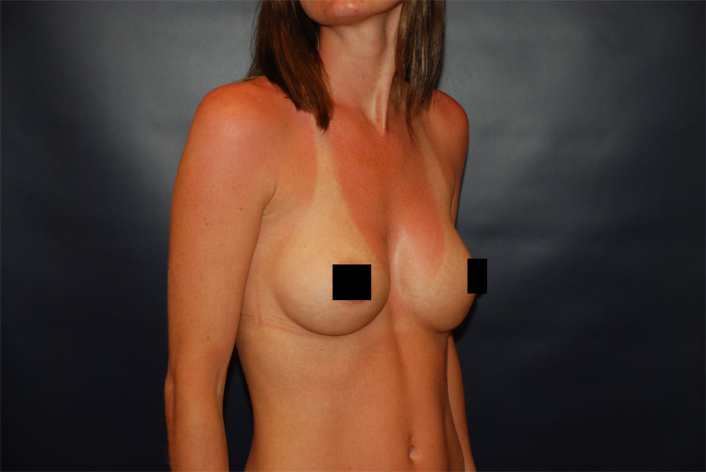 Breast Augmentation AFTER