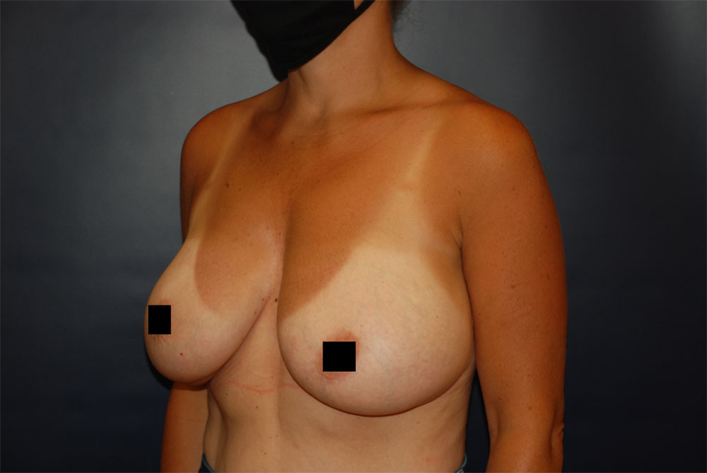 Breast Augmentation AFTER