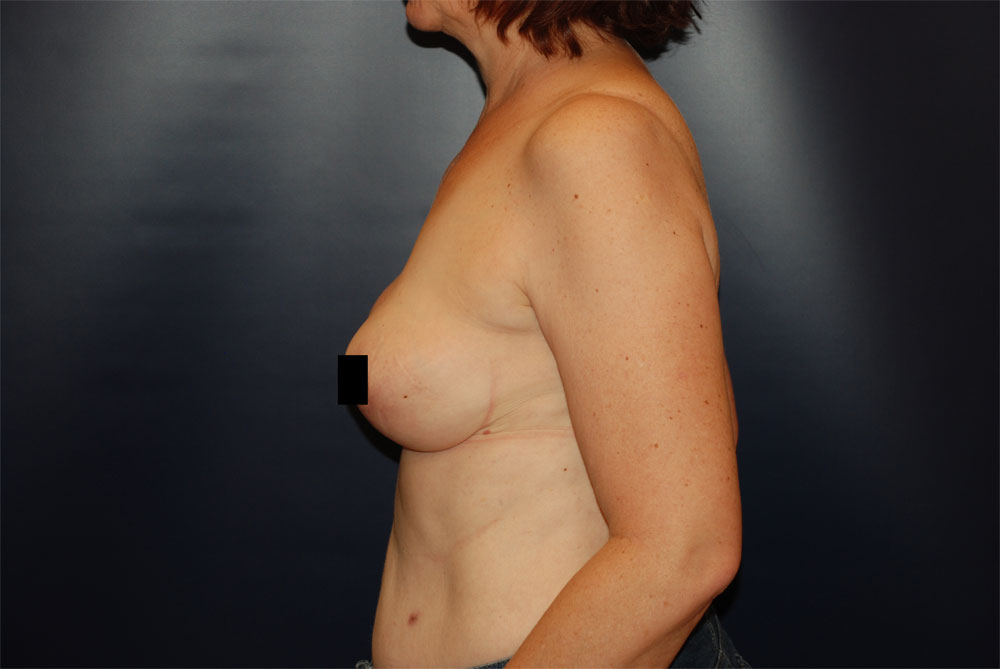 Breast Reduction AFTER