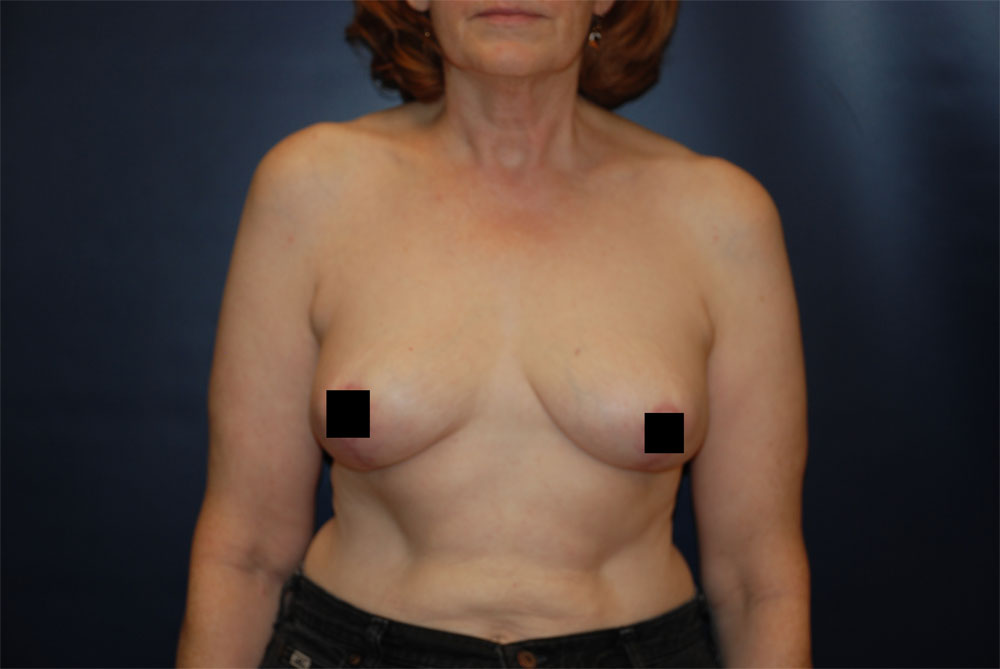 Breast Reduction AFTER