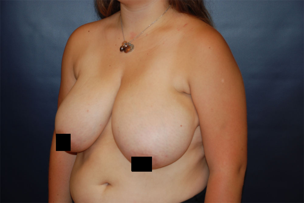 Breast Reduction BEFORE
