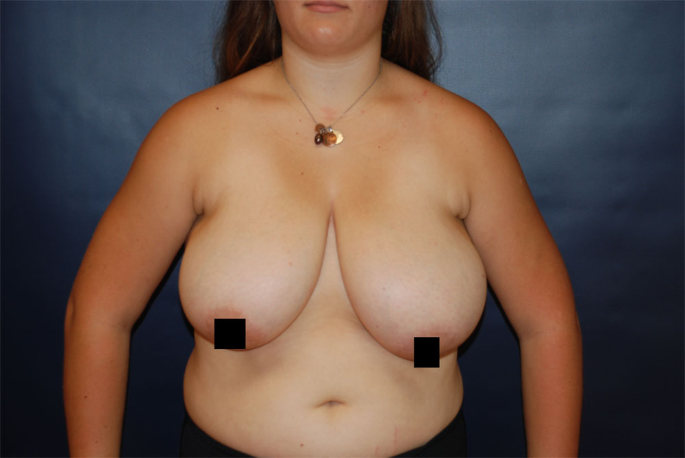 Breast Reduction BEFORE