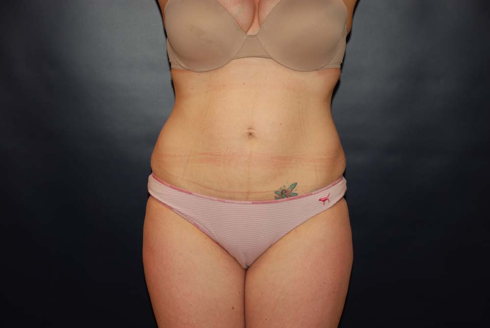 Liposuction BEFORE