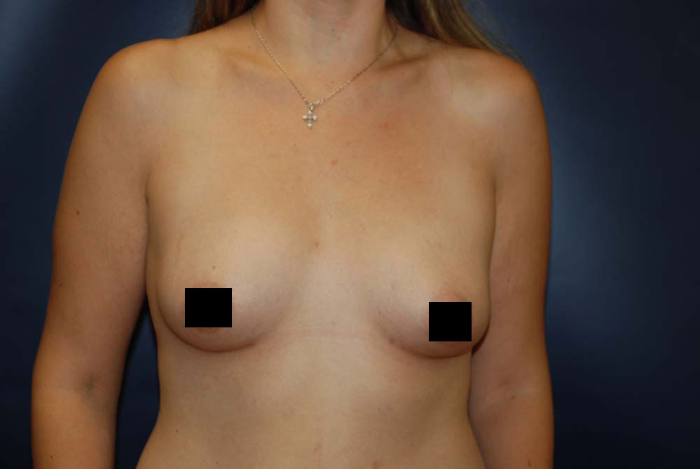 Liposuction AFTER
