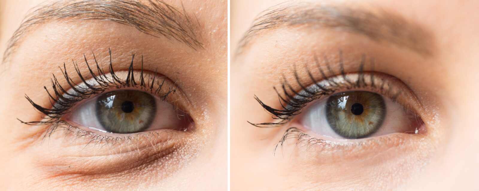 A before & after of a Blepharoplasty